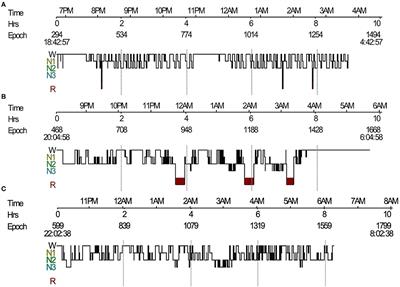 Corrigendum: Sleep Disorders in Leucine-Rich Glioma-Inactivated Protein 1 and Contactin Protein-Like 2 Antibody-Associated Diseases